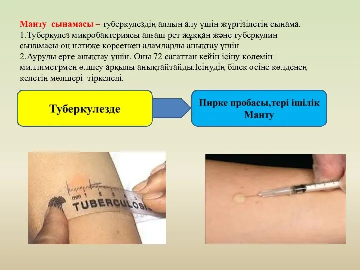 Манту сынамасы – туберкулездің алдын алу үшін жүргізілетін сынама. 1.Туберкулез