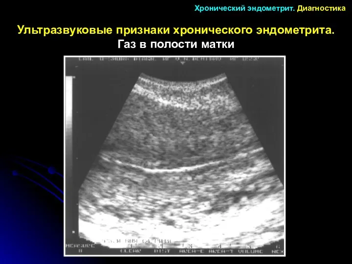 Ультразвуковые признаки хронического эндометрита. Газ в полости матки Хронический эндометрит. Диагностика