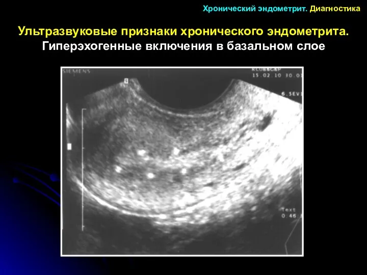 Ультразвуковые признаки хронического эндометрита. Гиперэхогенные включения в базальном слое Хронический эндометрит. Диагностика