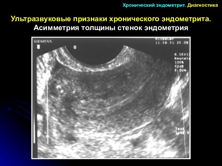 Ультразвуковые признаки хронического эндометрита. Асимметрия толщины стенок эндометрия Хронический эндометрит. Диагностика