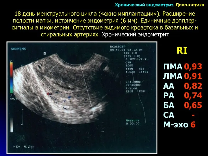 18 день менструального цикла («окно имплантации»). Расширение полости матки, истончение