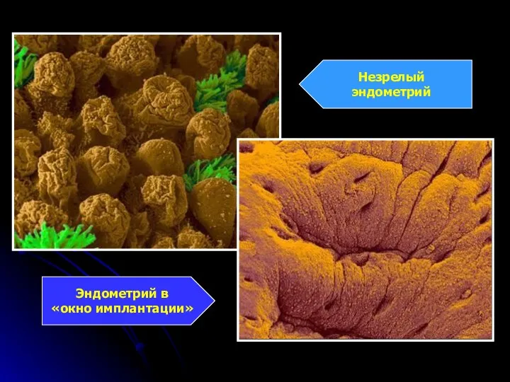 Эндометрий в «окно имплантации» Незрелый эндометрий