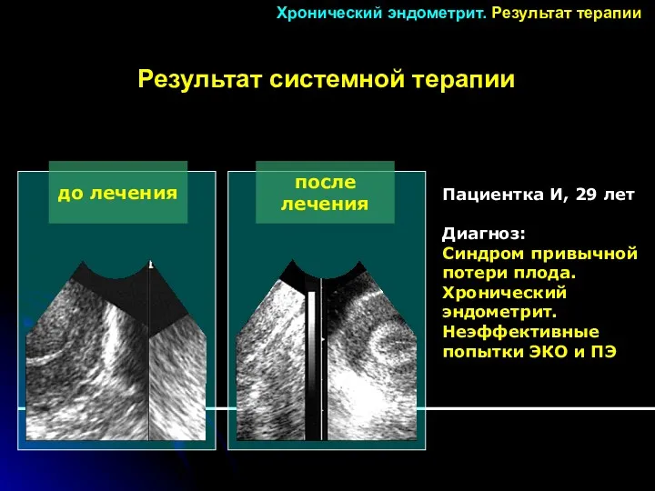 до лечения после лечения Пациентка И, 29 лет Диагноз: Синдром