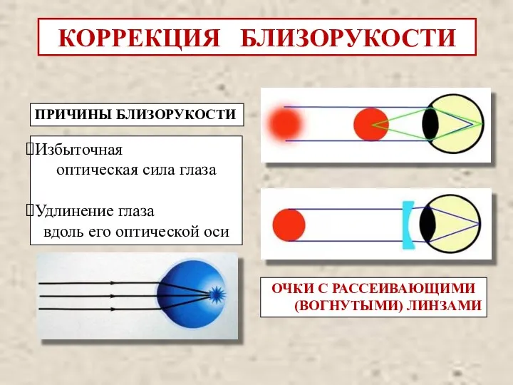 КОРРЕКЦИЯ БЛИЗОРУКОСТИ ПРИЧИНЫ БЛИЗОРУКОСТИ Избыточная оптическая сила глаза Удлинение глаза