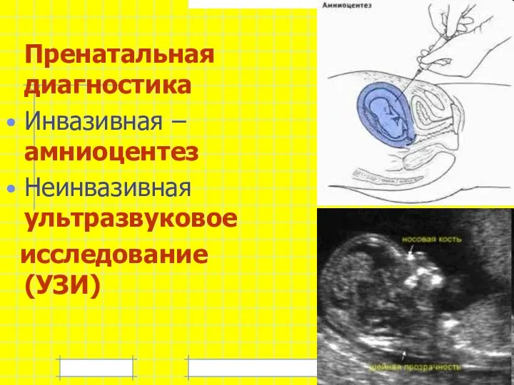 Пренатальная диагностика Инвазивная – амниоцентез Неинвазивная ультразвуковое исследование (УЗИ)