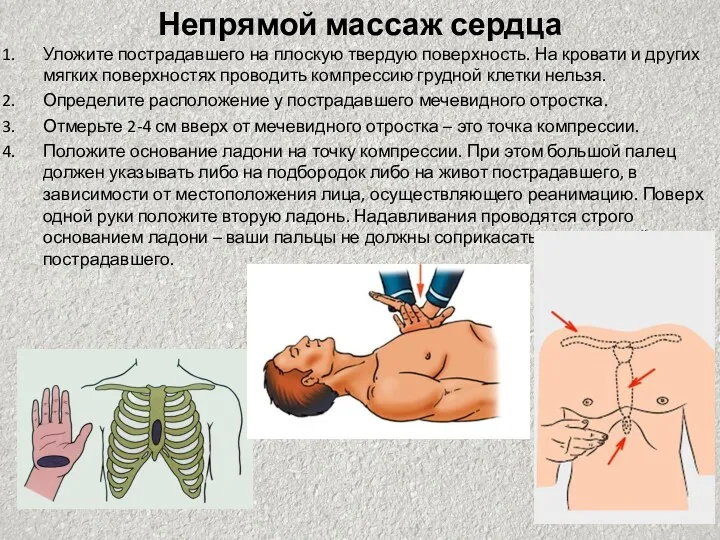 Непрямой массаж сердца Уложите пострадавшего на плоскую твердую поверхность. На