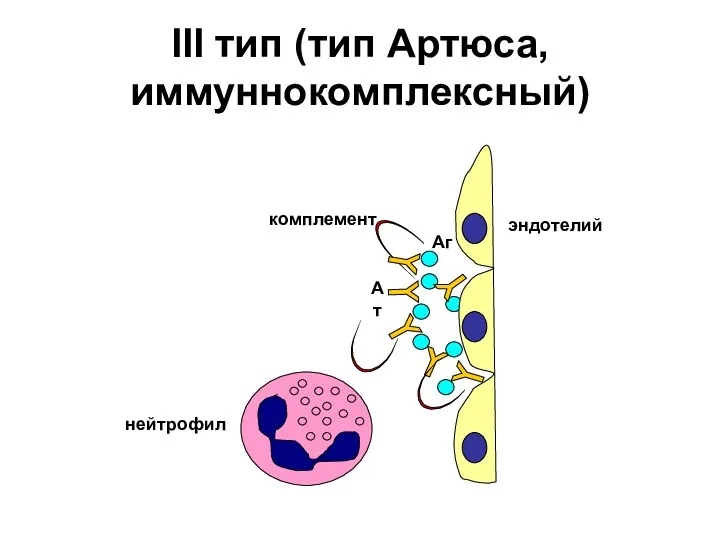 III тип (тип Артюса, иммуннокомплексный)