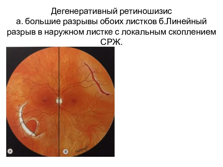 Дегенеративный ретиношизис а. большие разрывы обоих листков б.Линейный разрыв в наружном листке с локальным скоплением СРЖ.
