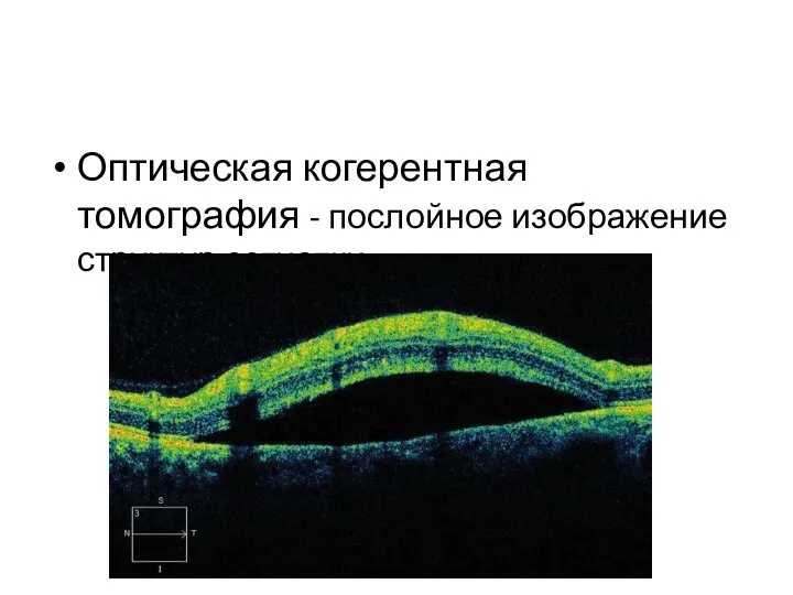 Оптическая когерентная томография - послойное изображение структур сетчатки