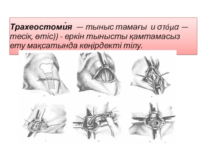 Трахеостоми́я — тыныс тамағы и στóμα — тесік, өтіс)) -