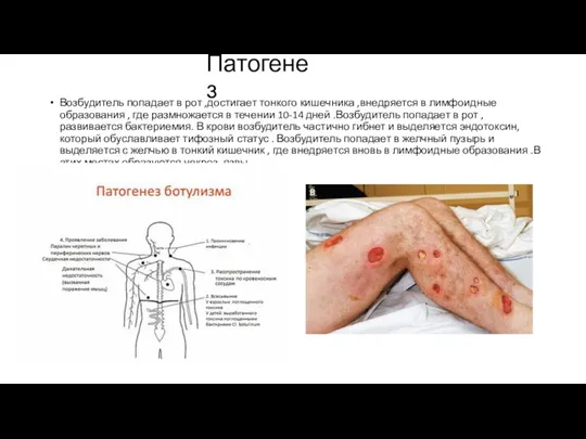 Патогенез Возбудитель попадает в рот ,достигает тонкого кишечника ,внедряется в