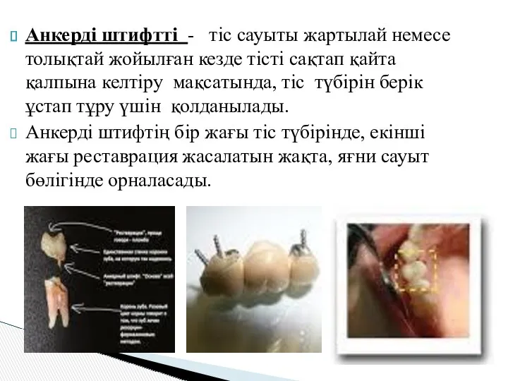 Анкерді штифтті - тіс сауыты жартылай немесе толықтай жойылған кезде тісті сақтап қайта