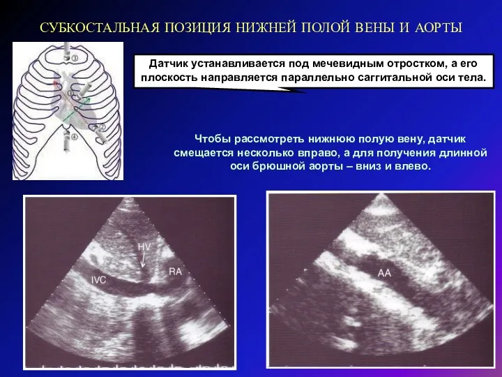 СУБКОСТАЛЬНАЯ ПОЗИЦИЯ НИЖНЕЙ ПОЛОЙ ВЕНЫ И АОРТЫ Датчик устанавливается под