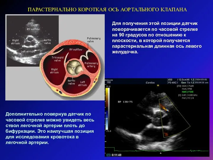 ПАРАСТЕРНАЛЬНО КОРОТКАЯ ОСЬ АОРТАЛЬНОГО КЛАПАНА Для получения этой позиции датчик