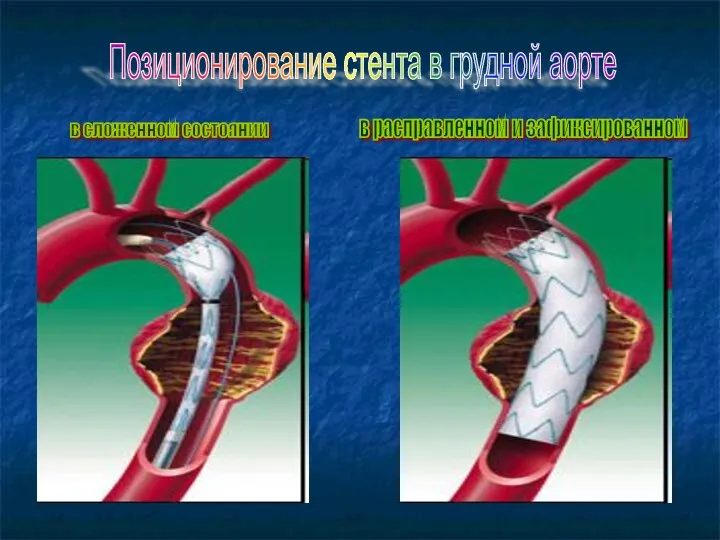Позиционирование стента в грудной аорте в сложенном состоянии в расправленном и зафиксированном