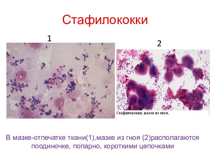 Стафилококки В мазке-отпечатке ткани(1),мазке из гноя (2)располагаются поодиночке, попарно, короткими цепочками 1 2