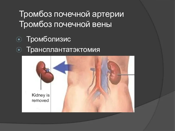 Тромбоз почечной артерии Тромбоз почечной вены Тромболизис Трансплантатэктомия Kidney is removed
