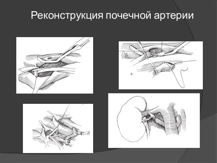 Реконструкция почечной артерии