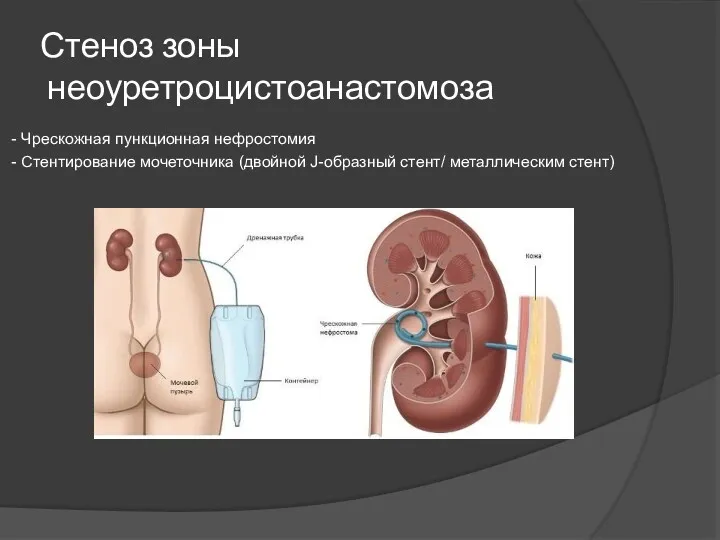 Стеноз зоны неоуретроцистоанастомоза - Чрескожная пункционная нефростомия - Стентирование мочеточника (двойной J-образный стент/ металлическим стент)