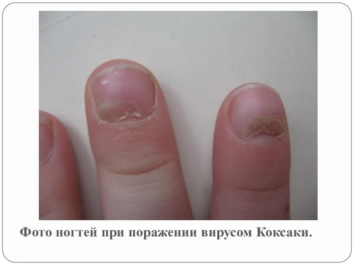 Фото ногтей при поражении вирусом Коксаки.