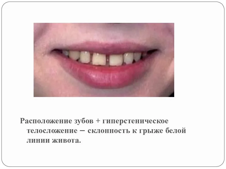 Расположение зубов + гиперстеническое телосложение – склонность к грыже белой линии живота.