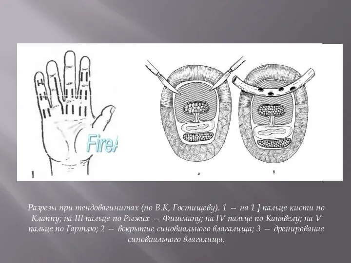 Разрезы при тендовагинитах (по В.К, Гостищеву). 1 — на 1