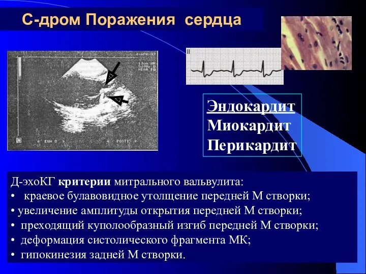 С-дром Поражения сердца Эндокардит Миокардит Перикардит Д-эхоКГ критерии митрального вальвулита: