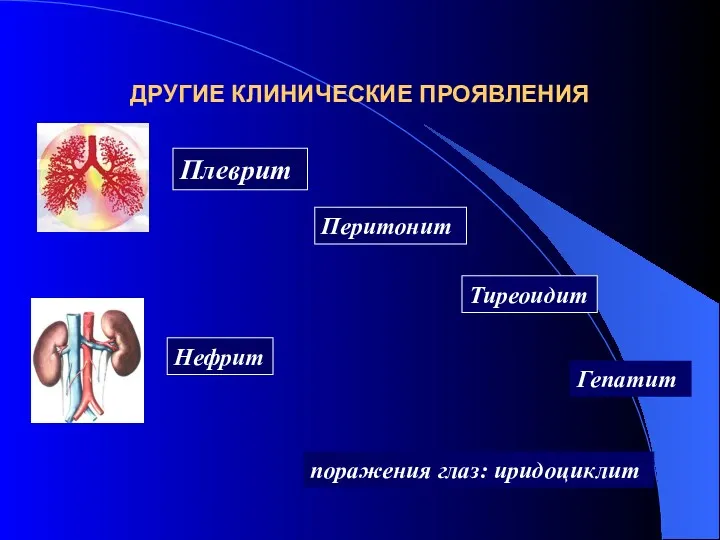 ДРУГИЕ КЛИНИЧЕСКИЕ ПРОЯВЛЕНИЯ Перитонит Гепатит поражения глаз: иридоциклит Тиреоидит Плеврит Нефрит