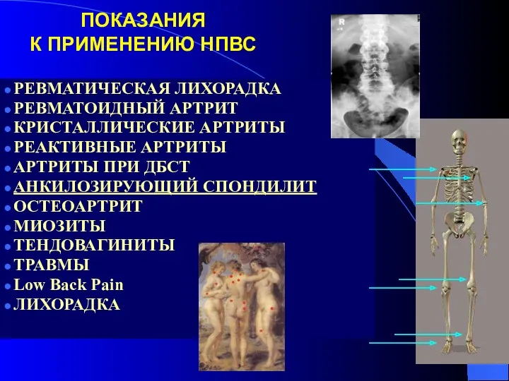 ПОКАЗАНИЯ К ПРИМЕНЕНИЮ НПВС РЕВМАТИЧЕСКАЯ ЛИХОРАДКА РЕВМАТОИДНЫЙ АРТРИТ КРИСТАЛЛИЧЕСКИЕ АРТРИТЫ