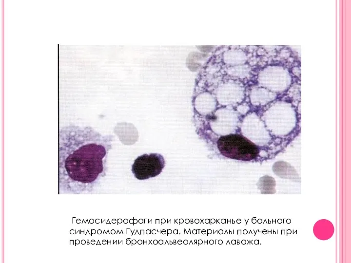 Гемосидерофаги при кровохарканье у больного синдромом Гудпасчера. Материалы получены при проведении бронхоальвеолярного лаважа.