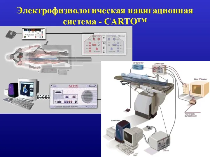 Электрофизиологическая навигационная система - CARTO™
