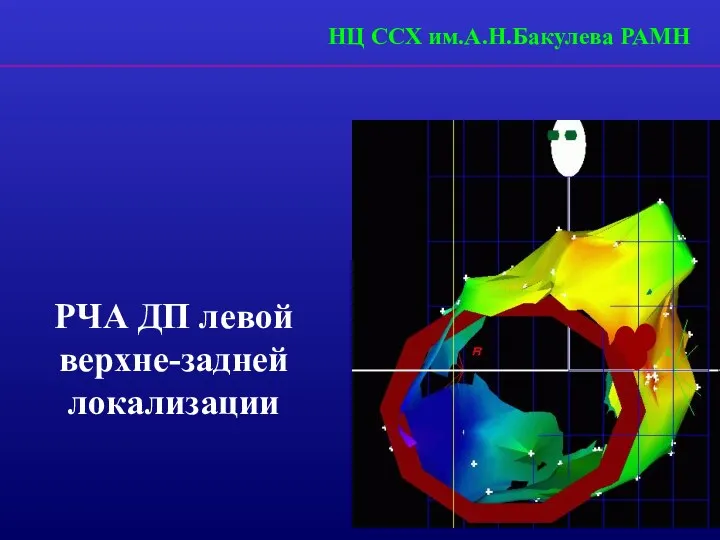 РЧА ДП левой верхне-задней локализации НЦ ССХ им.А.Н.Бакулева РАМН