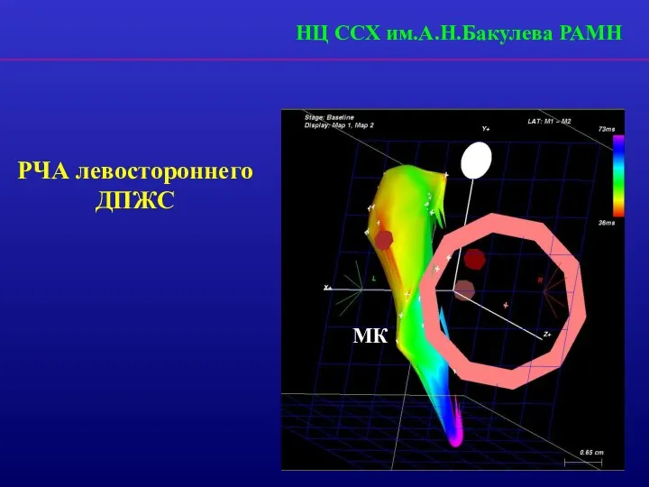 МК РЧА левостороннего ДПЖС НЦ ССХ им.А.Н.Бакулева РАМН