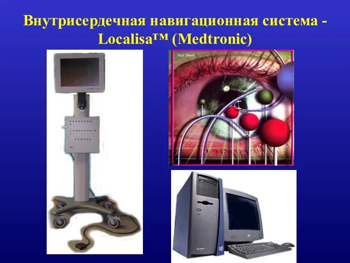Внутрисердечная навигационная система - Localisa™ (Medtronic)