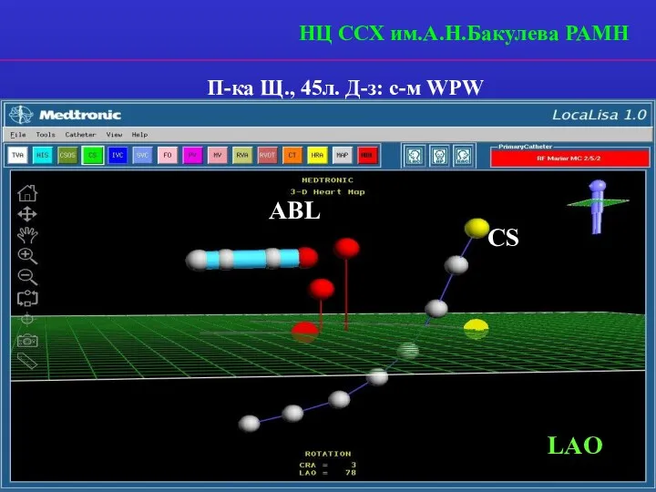 LAO CS ABL П-ка Щ., 45л. Д-з: с-м WPW НЦ ССХ им.А.Н.Бакулева РАМН