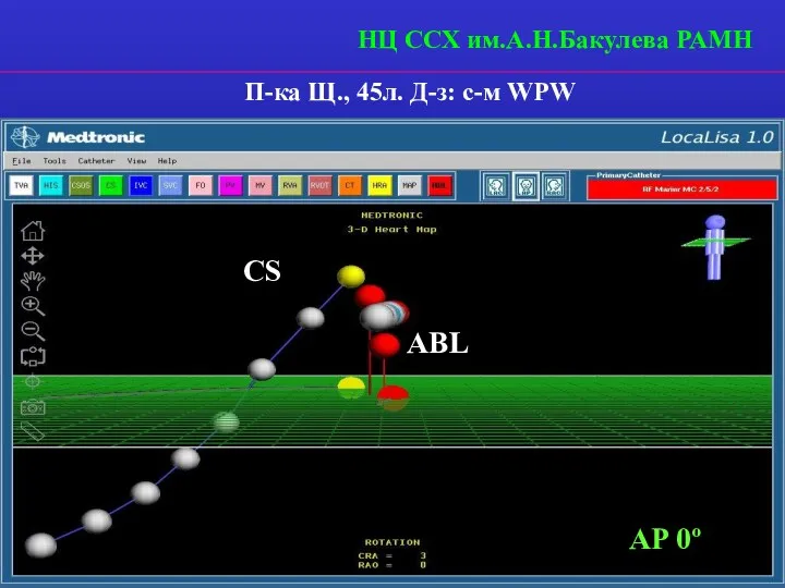 CS ABL AP 0º П-ка Щ., 45л. Д-з: с-м WPW НЦ ССХ им.А.Н.Бакулева РАМН