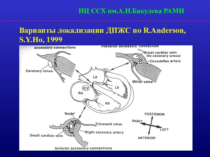 Варианты локализации ДПЖС по R.Anderson, S.Y.Ho, 1999 НЦ ССХ им.А.Н.Бакулева РАМН