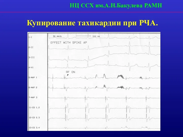 НЦ ССХ им.А.Н.Бакулева РАМН Купирование тахикардии при РЧА.