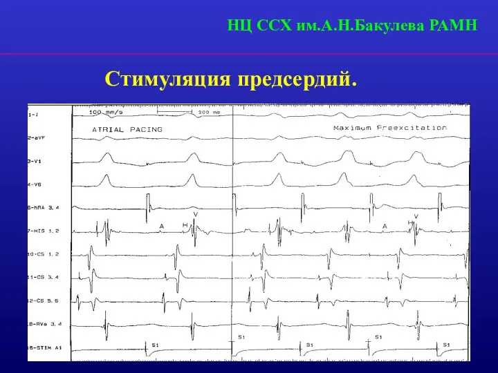 НЦ ССХ им.А.Н.Бакулева РАМН Стимуляция предсердий.