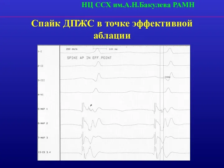 Спайк ДПЖС в точке эффективной аблации НЦ ССХ им.А.Н.Бакулева РАМН