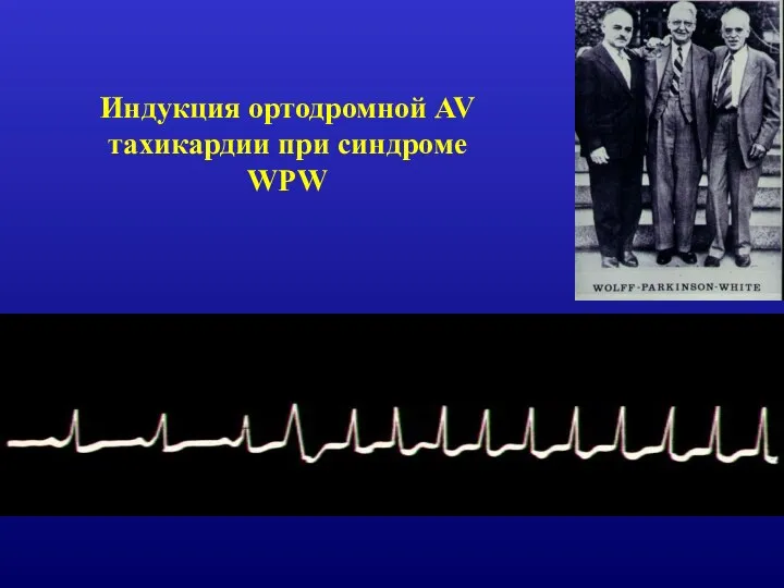 Индукция ортодромной AV тахикардии при синдроме WPW