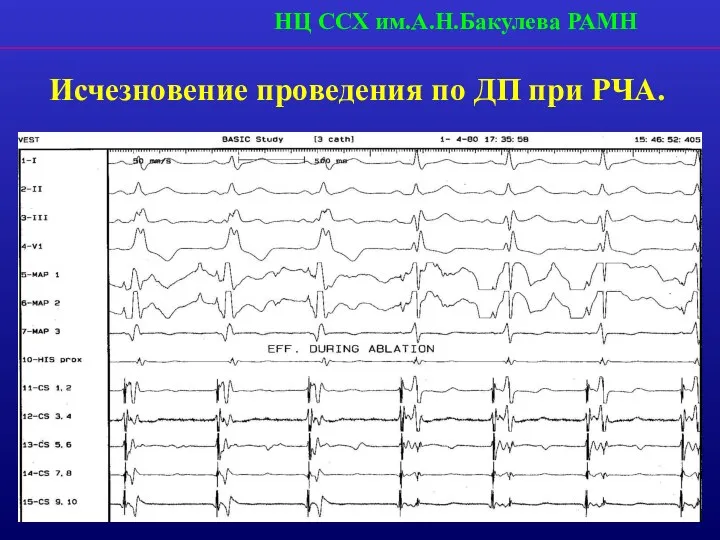 НЦ ССХ им.А.Н.Бакулева РАМН Исчезновение проведения по ДП при РЧА.