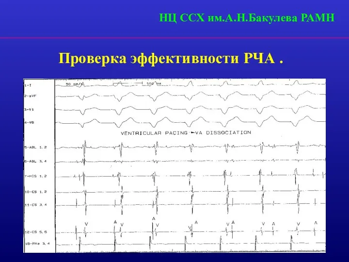 НЦ ССХ им.А.Н.Бакулева РАМН Проверка эффективности РЧА .