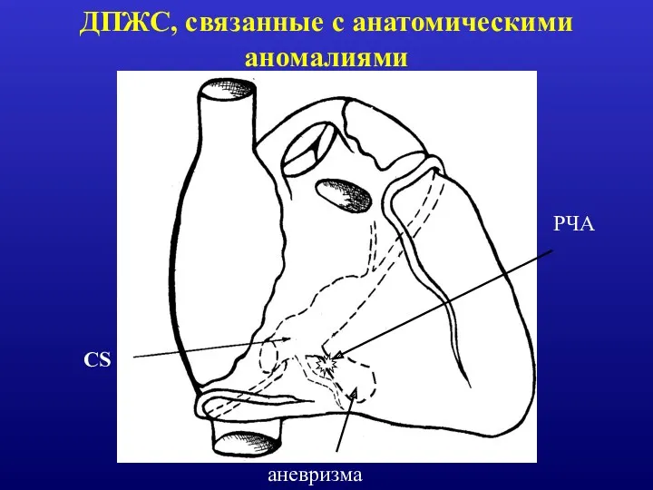 РЧА ДПЖС, связанные с анатомическими аномалиями