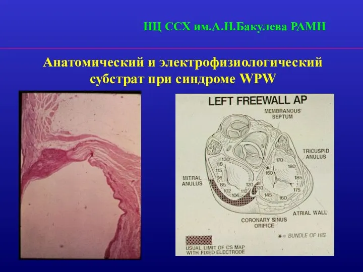 Анатомический и электрофизиологический субстрат при синдроме WPW НЦ ССХ им.А.Н.Бакулева РАМН