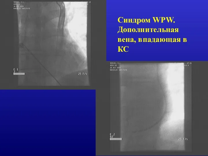 Синдром WPW. Дополнительная вена, впадающая в КС