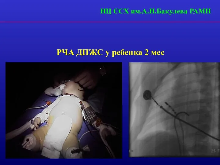 РЧА ДПЖС у ребенка 2 мес НЦ ССХ им.А.Н.Бакулева РАМН