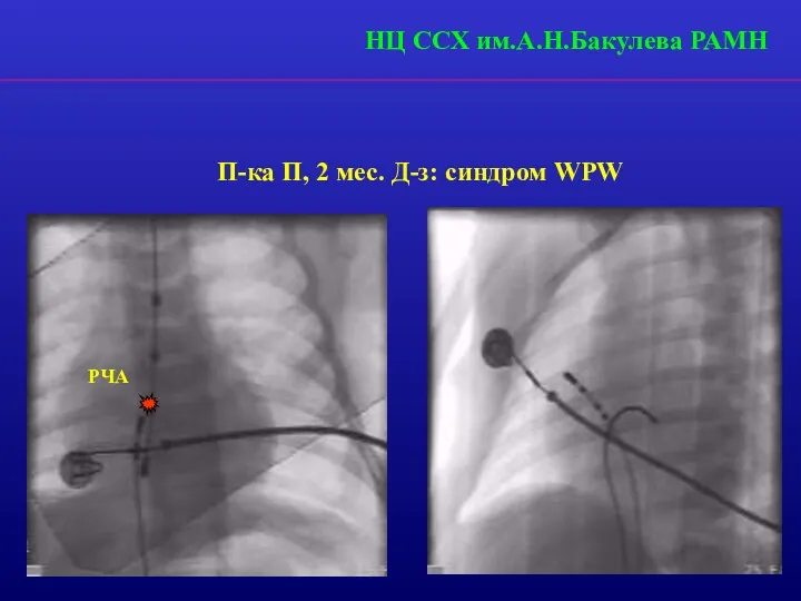 П-ка П, 2 мес. Д-з: синдром WPW РЧА НЦ ССХ им.А.Н.Бакулева РАМН