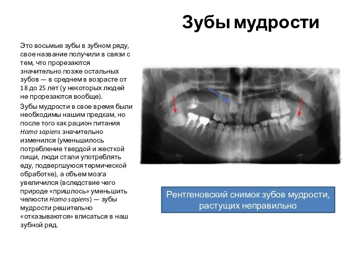 Зубы мудрости Это восьмые зубы в зубном ряду, свое название