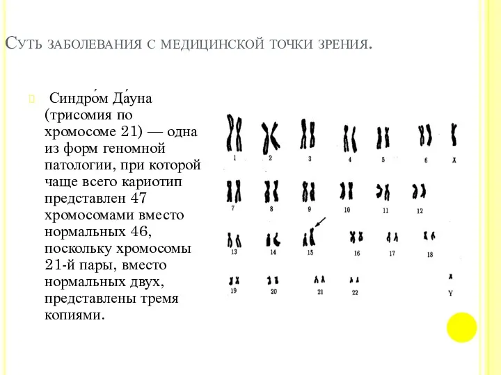 Суть заболевания с медицинской точки зрения. Синдро́м Да́уна (трисомия по